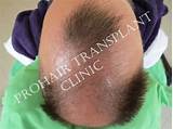 Which Doctor To See For Hair Loss Treatment Pictures
