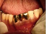 Gold Teeth Dentist Images