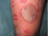 What Is The Latest Treatment For Psoriasis