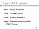 Anaplastic Astrocytoma Grade 3 Treatment Images