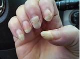 Bad Fingernails Treatment Images