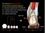 Rearfoot Varus Treatment Pictures