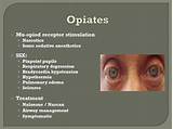 Opiates Depression Treatment Pictures