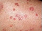 Images of Underarm Rash Treatment Webmd