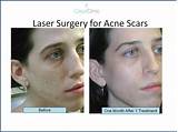 Acne Laser Treatment Nyc Photos