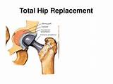 Pictures of Partial Hip Replacement Recovery Time Elderly