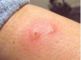 Pictures of Harvoni Side Effects Rash