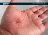 Images of Colloidal Silver Wound Healing