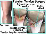 Osgood Schlatter Surgery Recovery Time Images