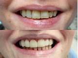Photos of Front Tooth Chipped Bonding