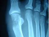 Pictures of Tibial Sesamoid Fracture Treatment