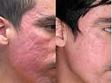 Pictures of Ayurvedic Treatment For Acne Scars