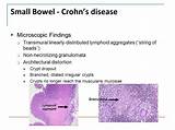Pictures of Small Bowel Crohn''s Treatment