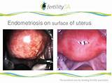Endometriosis Fertility Treatment Options Photos