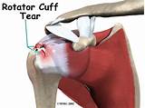 Images of Physical Therapy For Rotator Cuff Surgery Recovery
