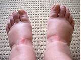 Photos of Which Doctor To Consult For Swelling In Feet
