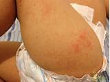 Pictures of Eczema Treatment During Pregnancy