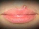 Images of Pimple On Lip Line Home Remedies