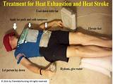 Pictures of Heat Exhaustion Heat Stroke Treatment