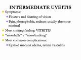 Photos of Uveitis Symptoms And Treatment