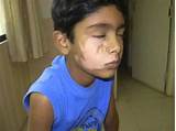 Segmental Vitiligo Treatment Images