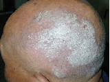 Pictures of Is There A Treatment For Psoriasis
