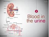 What Medications Can Cause Blood In Urine Photos