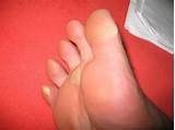 Images of Best Treatment For Corns And Calluses