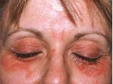 Seborrheic Dermatitis Eyelids Treatment Images