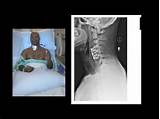 Images of Laminectomy Recovery Stories