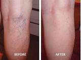 Spider Vein Treatment Before And After Pictures