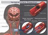 Photos of Carotid Artery Stroke Recovery