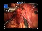 Pictures of Robotic Partial Nephrectomy Recovery Time