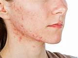 What Can A Doctor Prescribe For Acne Pictures