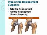 Photos of Hip Fracture Surgery Recovery Time