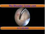Complications Of Shoulder Surgery Treatment And Prevention Photos