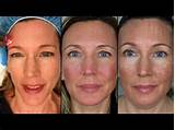 Photos of Recovery Time Co2 Laser Skin Resurfacing