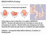 Can A Baby Get Stuck In The Fallopian Tube Photos