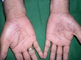 Images of Palmar Psoriasis Home Remedies