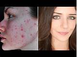 Pictures of Makeup Tips For Acne Scars