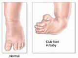 Pictures of Clubfoot Treatment Cost