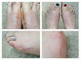 Images of Foot Surgery For Bunions Recovery