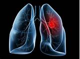 Genetic Lung Cancer Treatment Pictures