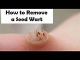 Pictures of Seed Wart Removal Home Remedies