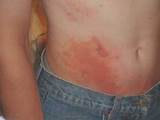 Pictures of Pigweed Allergy Treatment