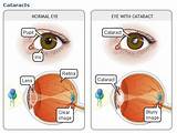 Photos of Cataract Surgery Recovery Exercise