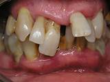 How Much Does Insurance Cover For Braces Images