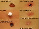 Images of Seed Wart Removal Home Remedies