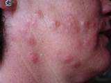 Photos of Bed Bug Treatment For Your Skin