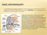 Exercise Program After Knee Arthroscopy Pictures